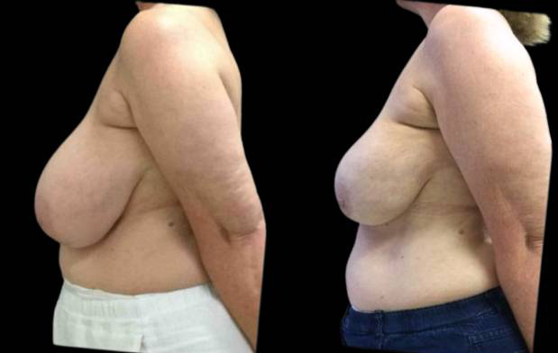60-year-old-female-breast-reduction-by-liposuction-before-and-after-side-view.jpg