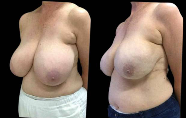 60-year-old-female-breast-reduction-by-liposuction-before-and-after-three-quarter-view.jpg