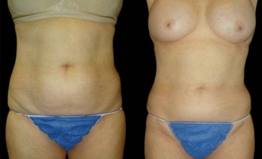 60-year-old-female-coolsculpting-before-and-after-front-view-16851.jpg