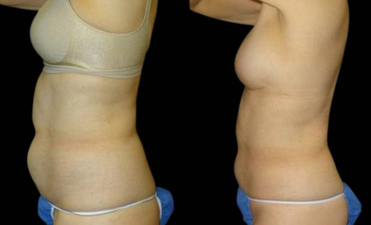60-year-old-female-coolsculpting-before-and-after-side-view.jpg