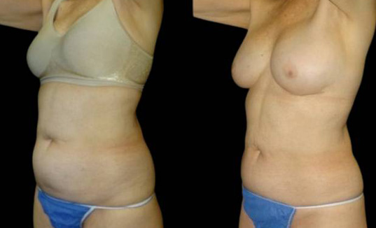 60-year-old-female-coolsculpting-before-and-after-three-quarters-view.jpg