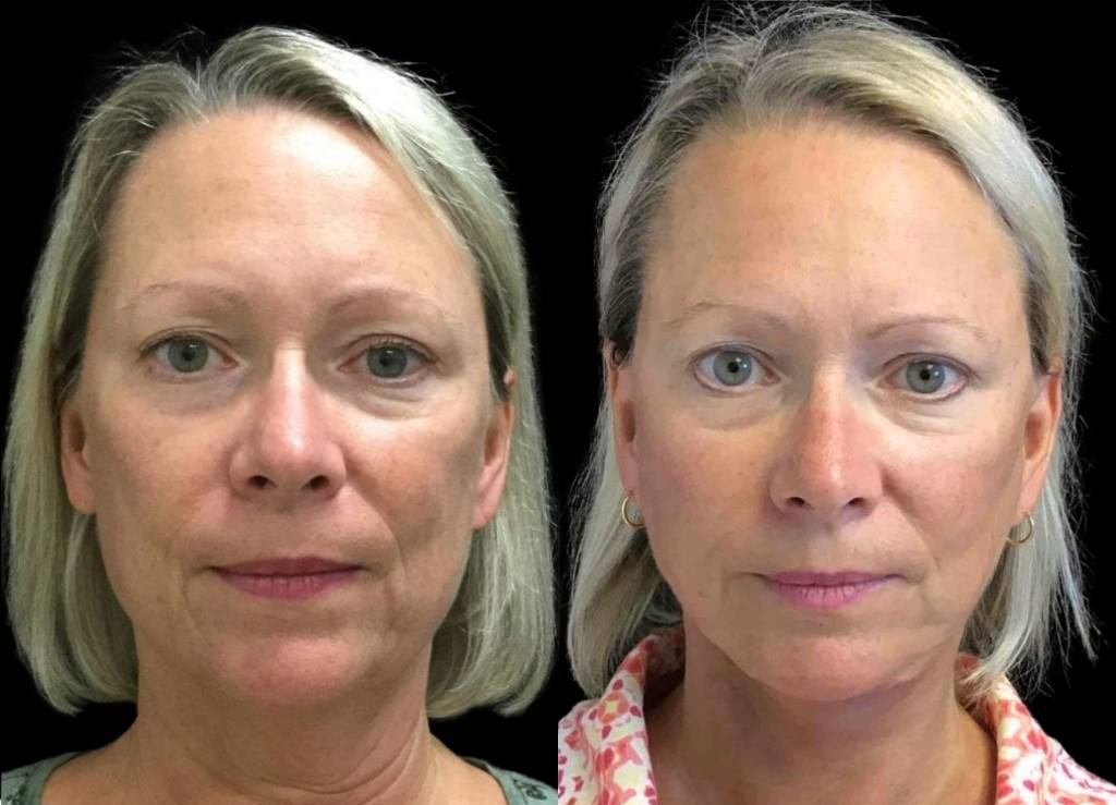 60-year-old-female-facelift-before-and-after-front-view-20933.jpg