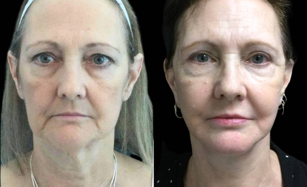 60-year-old-female-fat-grafting-before-and-after-front-view-20335.jpg