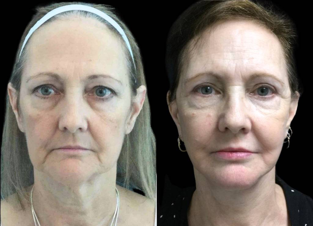 60-year-old-female-fat-grafting-before-and-after-front-view-20335.jpg