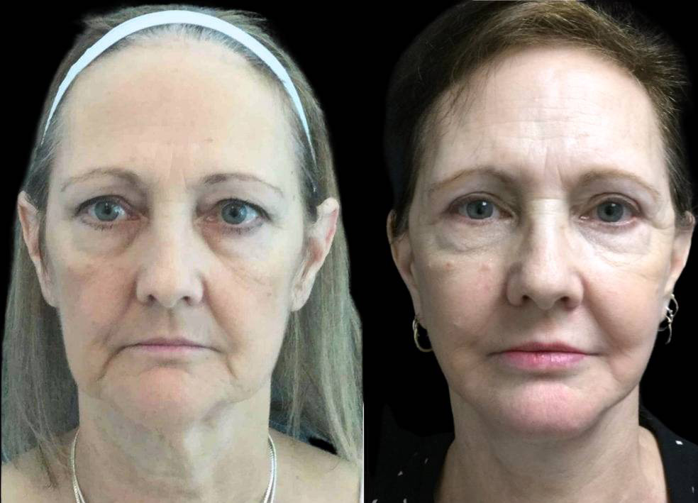 60-year-old-female-fat-grafting-before-and-after-front-view-20335.jpg