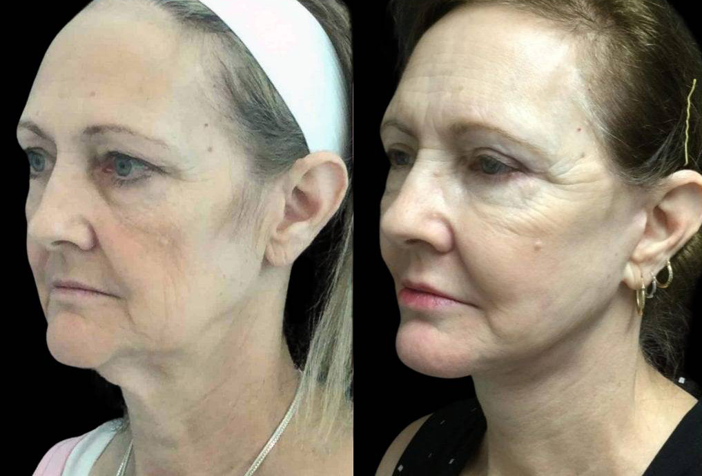 60-year-old-female-fat-grafting-before-and-after-three-quarters-view.jpg
