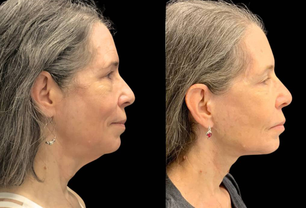60-year-old-female-necklift-before-and-after-side-view-28932.jpg