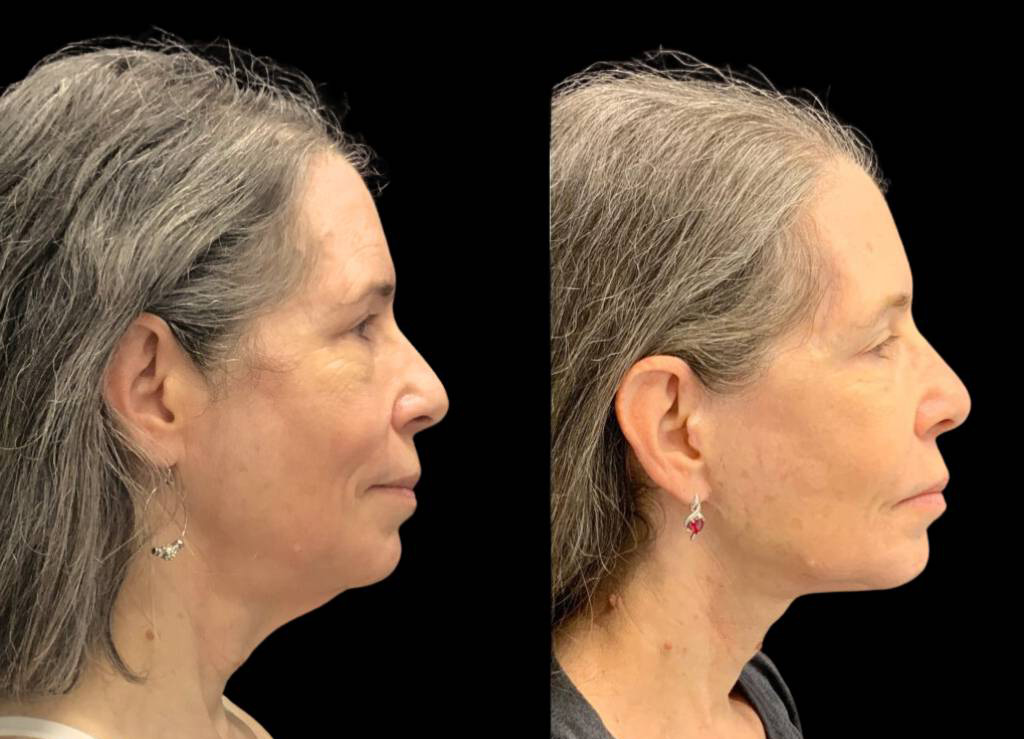 60-year-old-female-necklift-before-and-after-side-view-28932.jpg