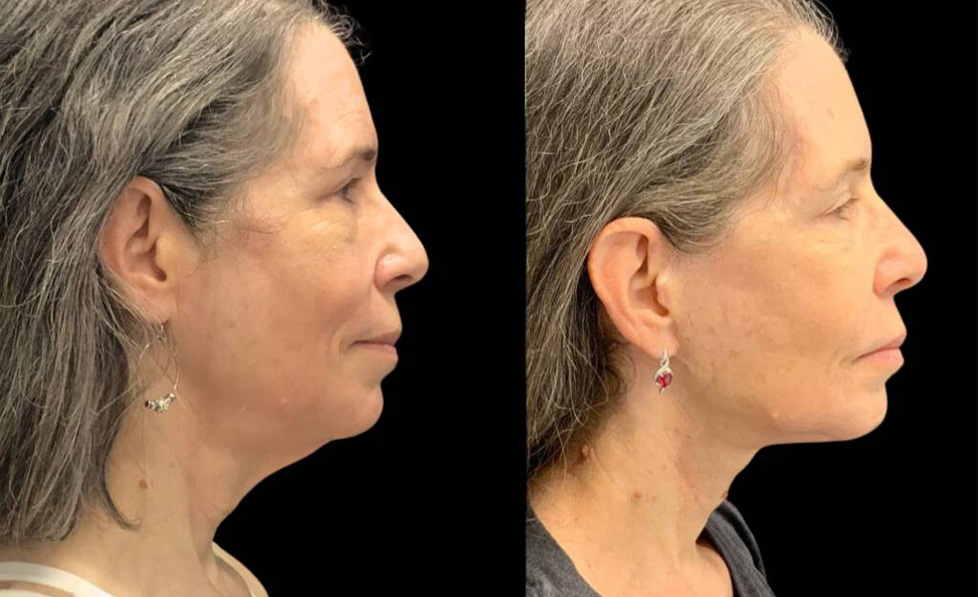 60-year-old-female-necklift-before-and-after-side-view-28932.jpg