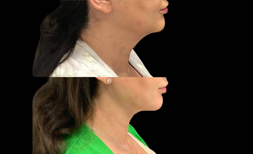 60-year-old-female-necklift-before-and-after-side-view-33358.jpg