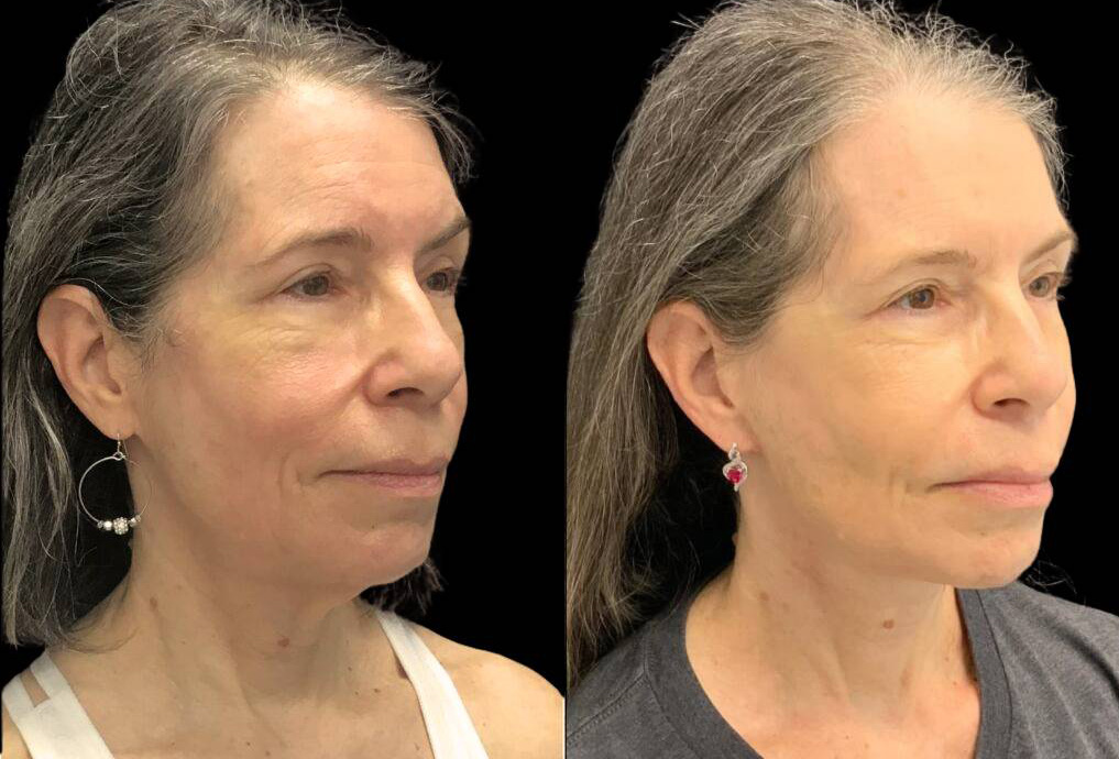 60-year-old-female-necklift-before-and-after-three-quarter-view.jpg