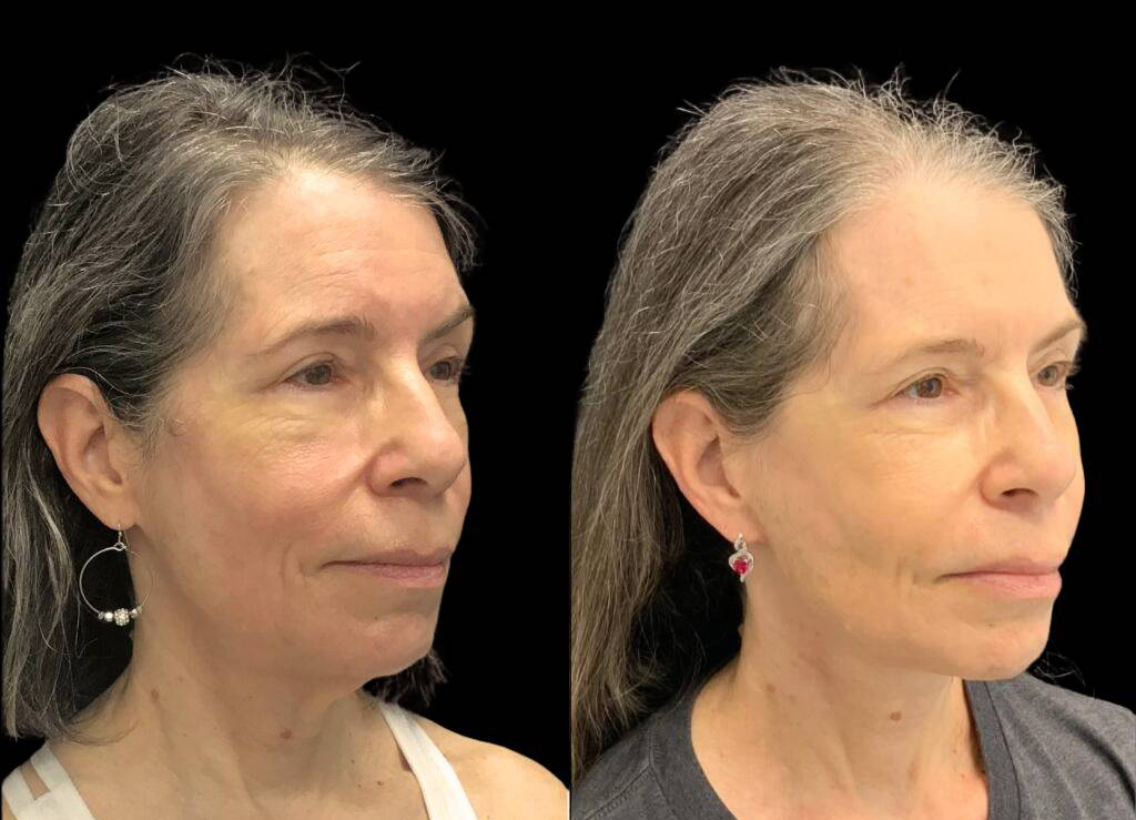 60-year-old-female-necklift-before-and-after-three-quarter-view.jpg
