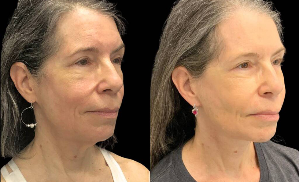 60-year-old-female-necklift-before-and-after-three-quarter-view.jpg