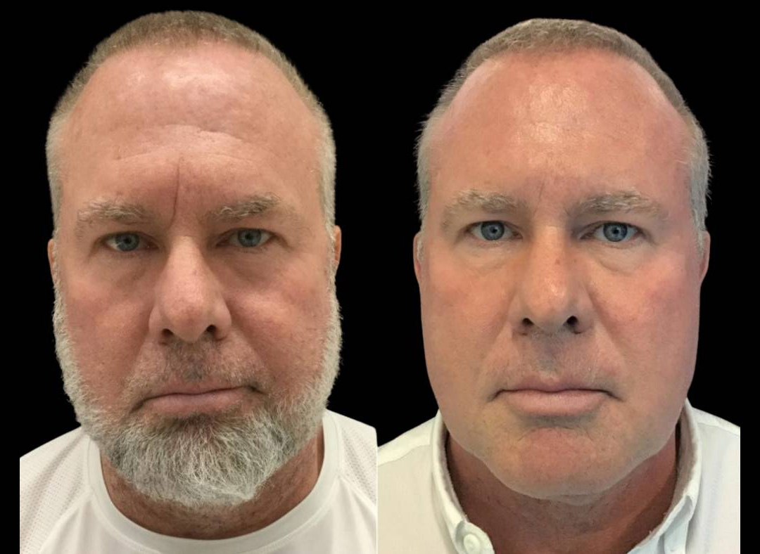 60-year-old-male-restylane-before-and-after-front-view-28023