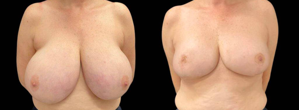 This is a 61-year-old female that has had a breast lift showing the before and after's side-by-side
