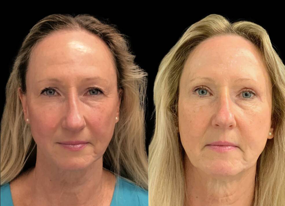 61-year-old-female-forehead-lift-before-and-after-front-view-.jpg