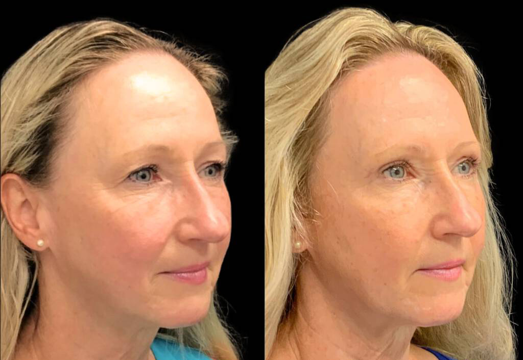 61-year-old-female-forehead-lift-before-and-after-three-quarter-view-.jpg