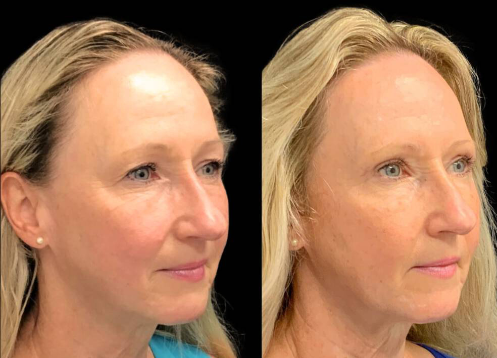 61-year-old-female-forehead-lift-before-and-after-three-quarter-view-.jpg