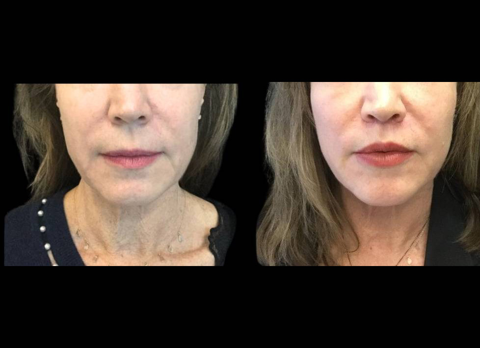 61-year-old-female-lip-lift-reduction-before-and-after-front-view.jpg