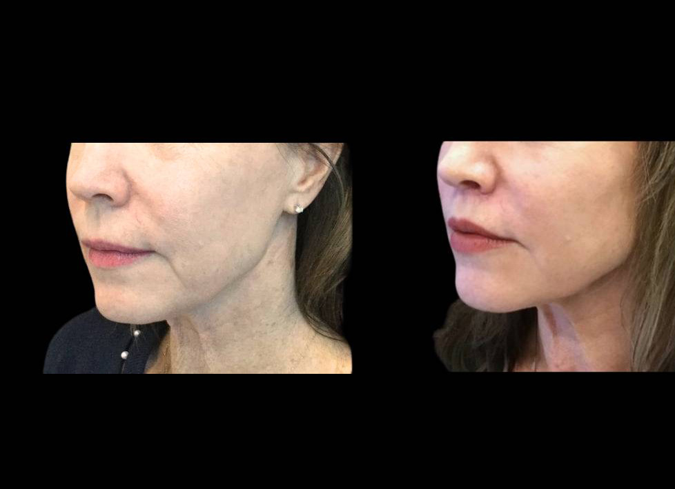 61-year-old-female-lip-lift-reduction-before-and-after-three-quarter-view.jpg