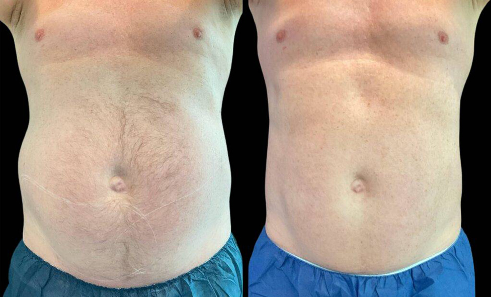 61-year-old-male-coolsculpting-before-and-after-front-view-36639.jpg