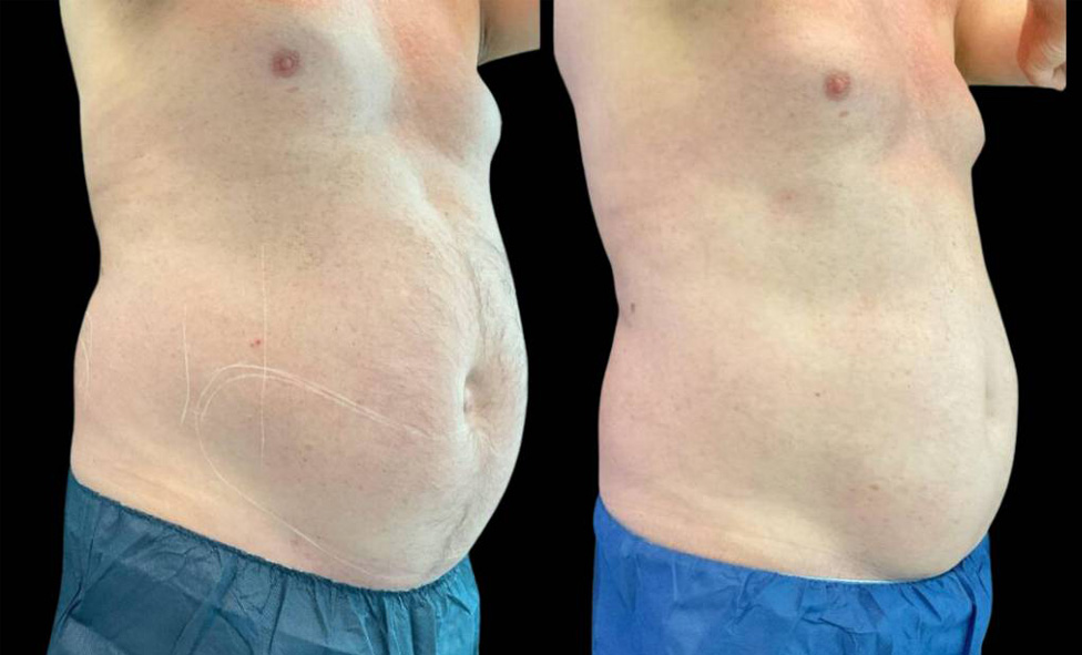 61-year-old-male-coolsculpting-before-and-after-three-quarter-view-1.jpg