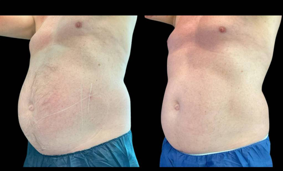 61-year-old-male-coolsculpting-before-and-after-three-quarter-view.jpg