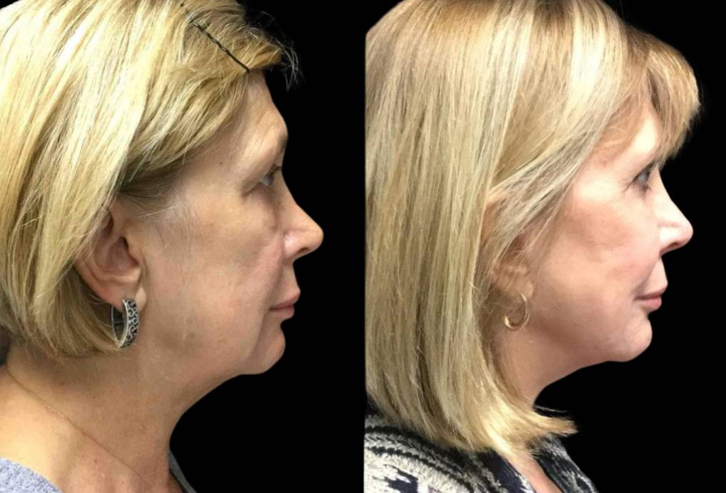 62-year-old-female-fat-grafting-before-and-after-side-view.jpg