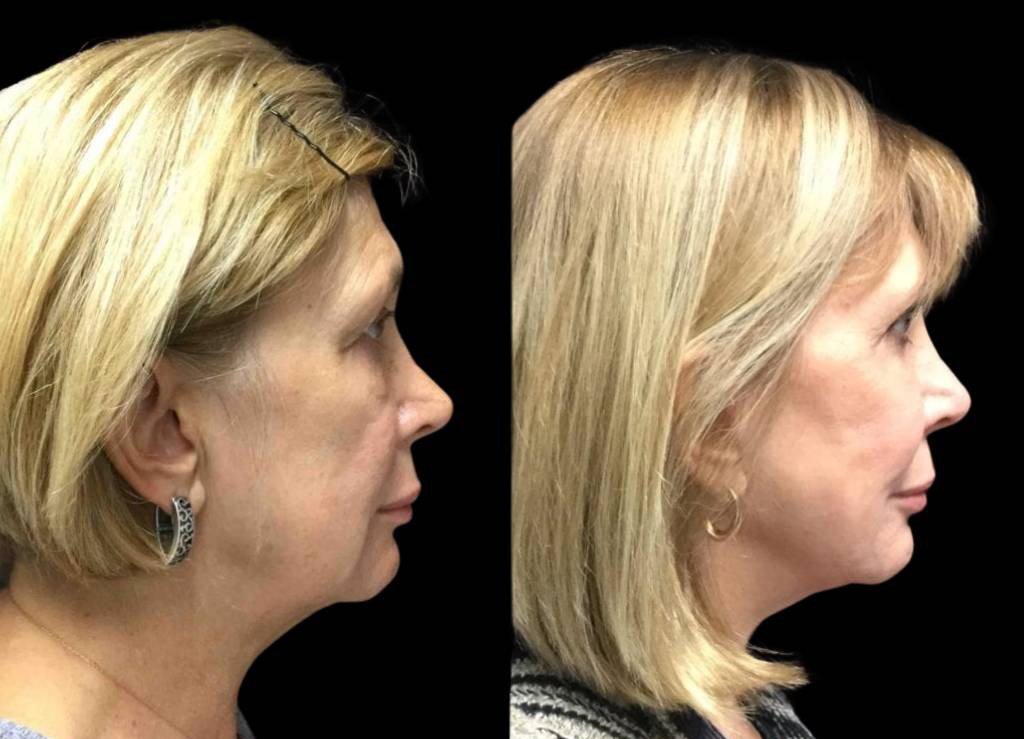 62-year-old-female-fat-grafting-before-and-after-side-view.jpg