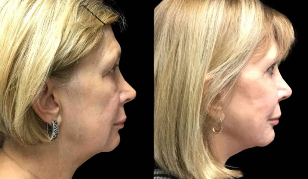 62-year-old-female-fat-grafting-before-and-after-side-view.jpg