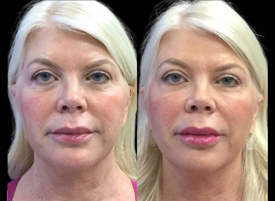 62-year-old-female-juvederm-before-and-after-front-view-29959.jpg