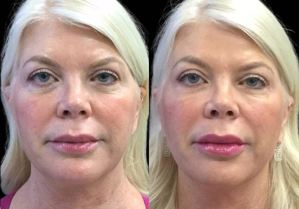 62-year-old-female-juvederm-before-and-after-front-view-29959.jpg
