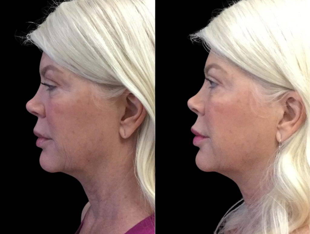 62-year-old-female-juvederm-before-and-after-side-view.jpg