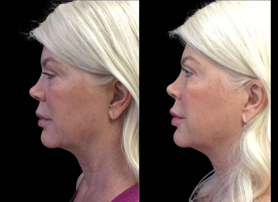 62-year-old-female-juvederm-before-and-after-side-view.jpg