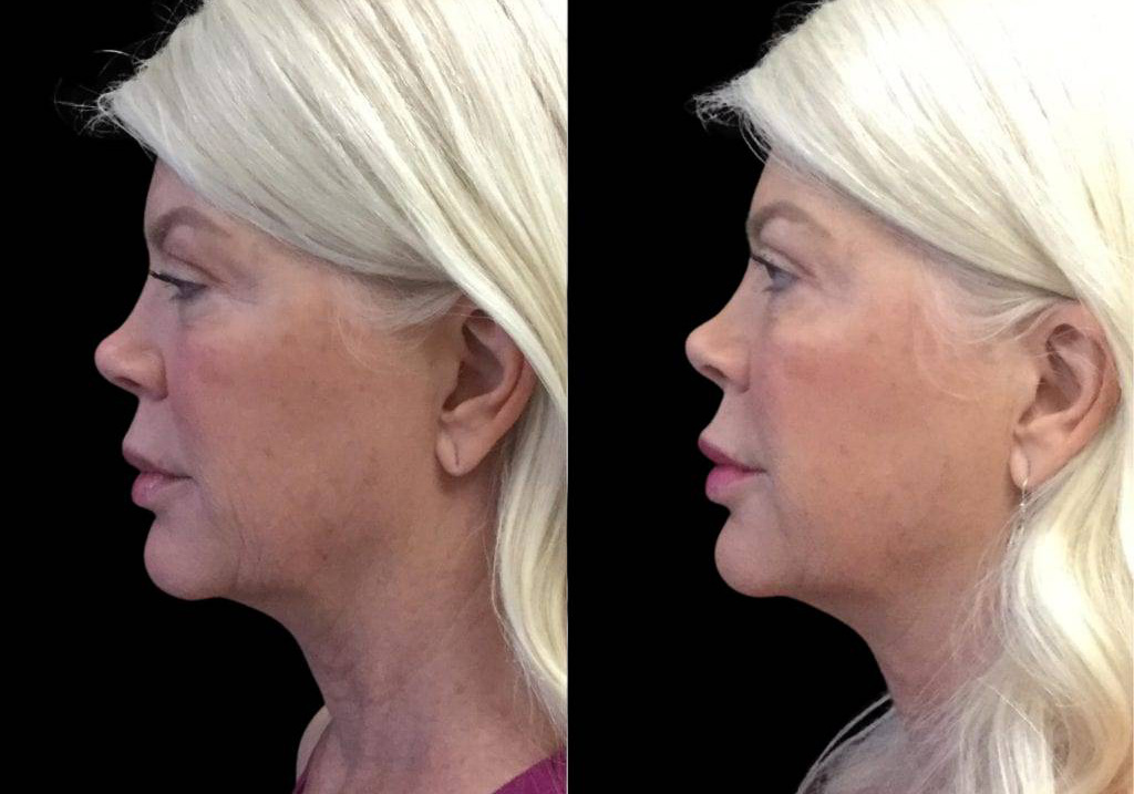 62-year-old-female-juvederm-before-and-after-side-view.jpg