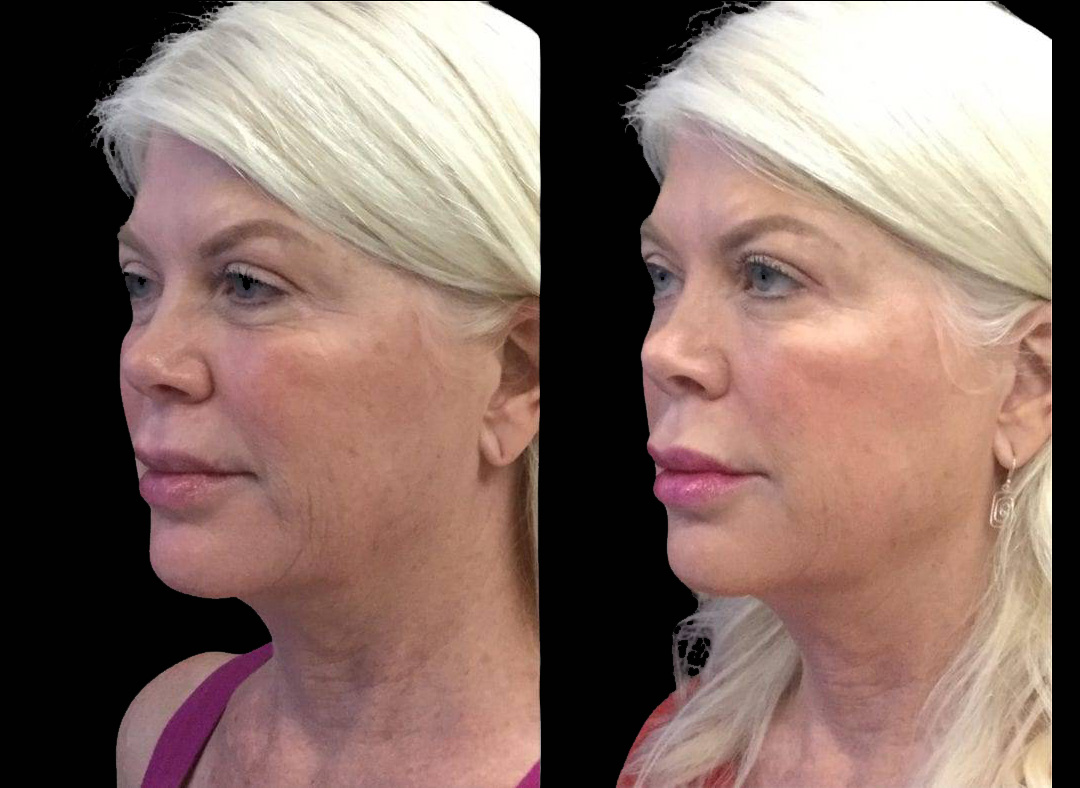 62-year-old-female-juvederm-before-and-after-three-quarter-view.jpg