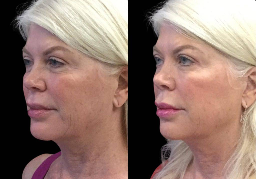 62-year-old-female-juvederm-before-and-after-three-quarter-view.jpg