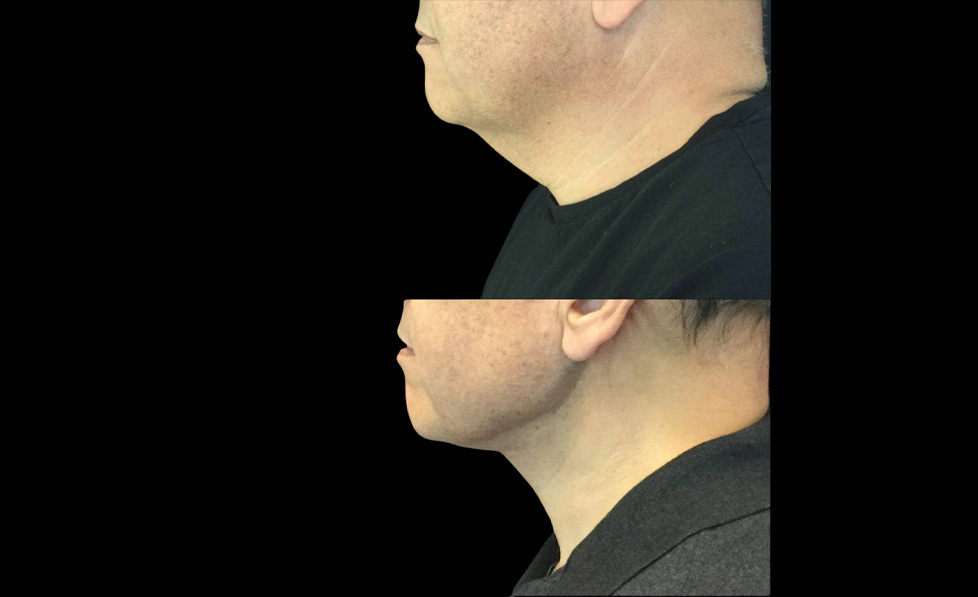 62-year-old-male-necklift-before-and-after-side-view-26991.jpg