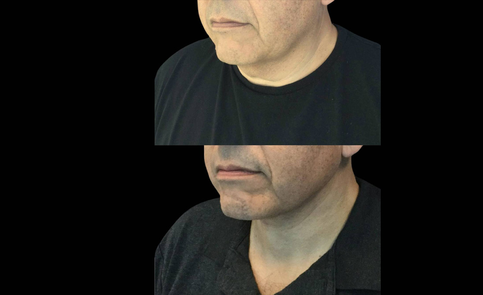 62-year-old-male-necklift-before-and-after-three-quarter-view.jpg