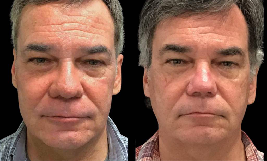 62-year-old-male-rhinophyma-reduction-before-and-after-front-view-1.jpg