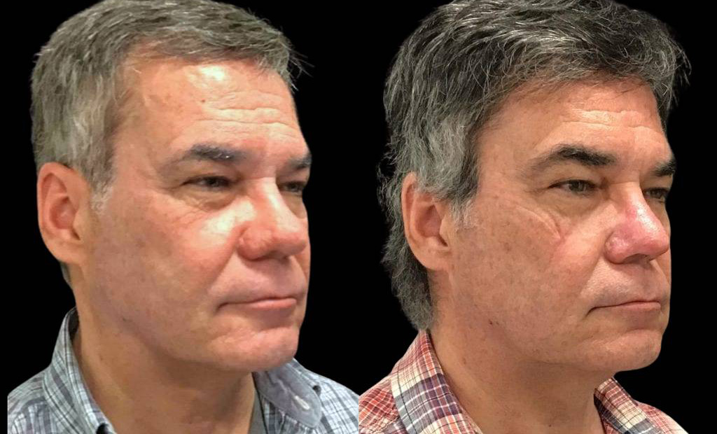 62-year-old-male-rhinophyma-reduction-before-and-after-three-quarter-view-1.jpg