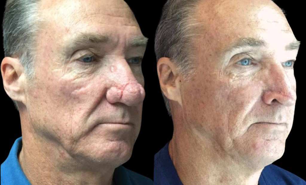 62-year-old-male-rhinophyma-reduction-before-and-after-three-quarter-view.jpg