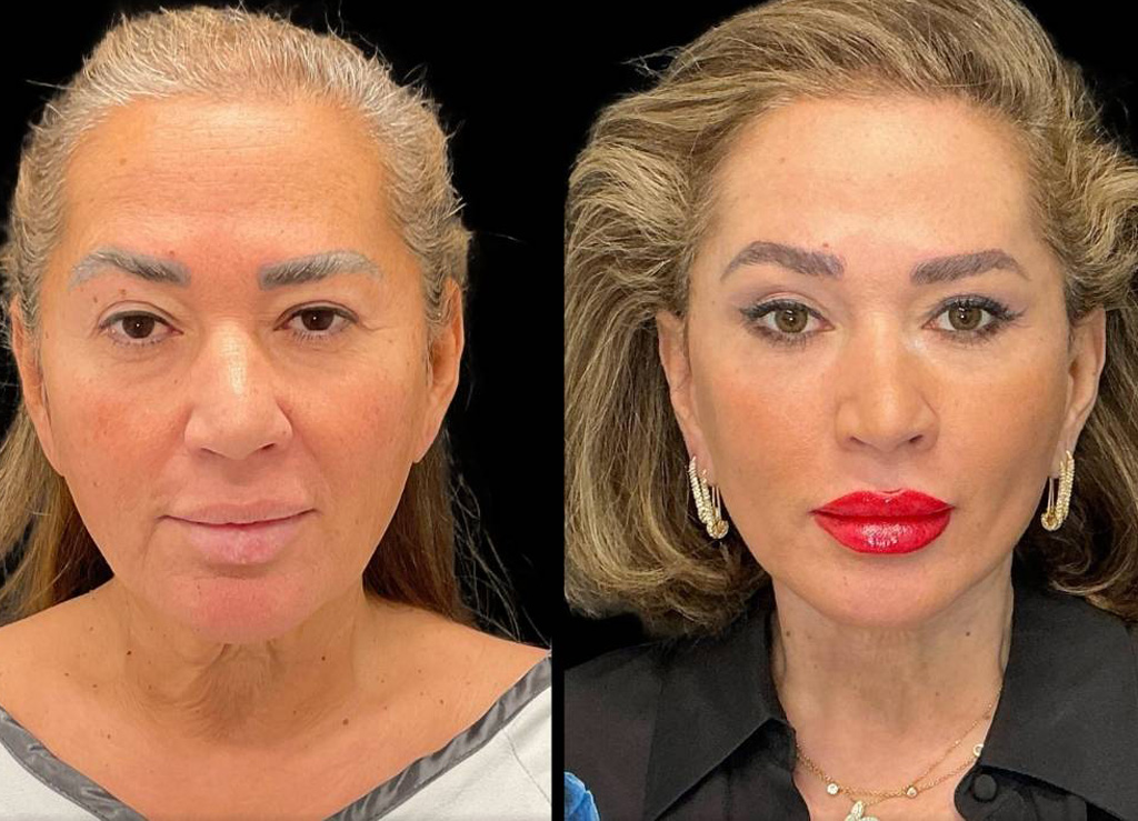 62-yr-old-female-facelift-before-and-after-front-view.jpg
