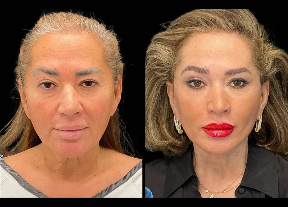 62-yr-old-female-facelift-before-and-after-front-view.jpg