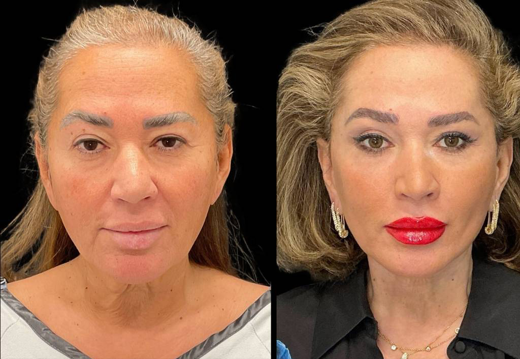 62-yr-old-female-facelift-before-and-after-front-view.jpg
