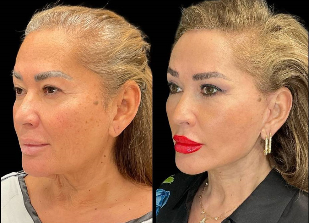 62-yr-old-female-facelift-before-and-after-left-three-quarter-view.jpg