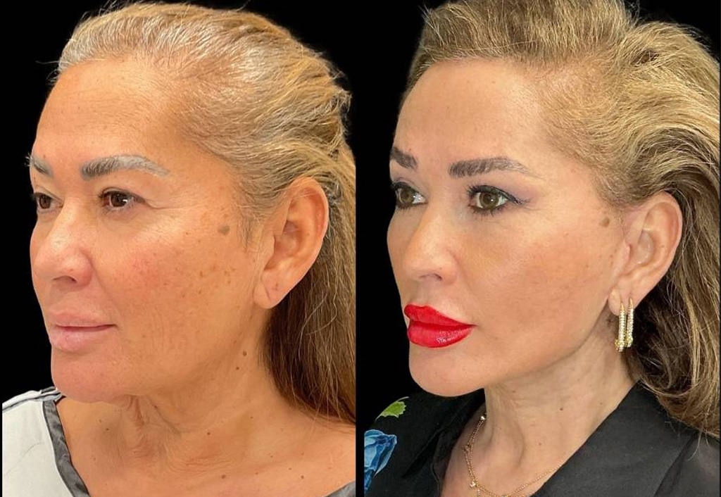 62-yr-old-female-facelift-before-and-after-left-three-quarter-view.jpg