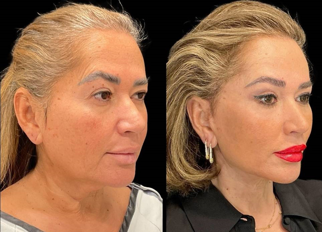 62-yr-old-female-facelift-before-and-after-right-three-quarter-view.jpg