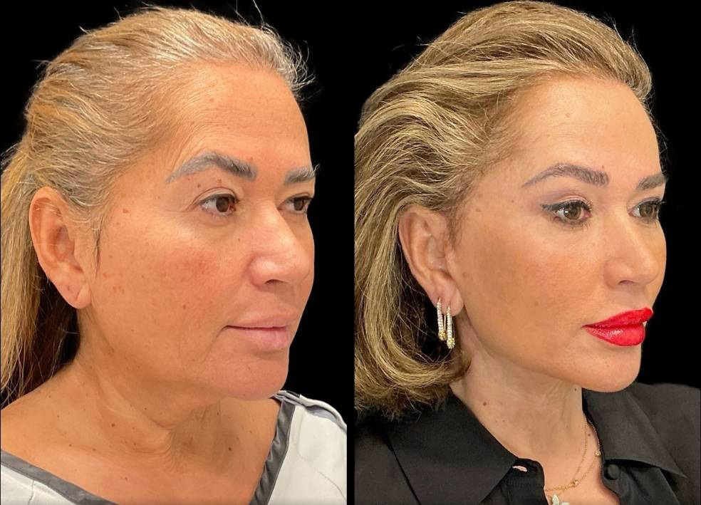 62-yr-old-female-facelift-before-and-after-right-three-quarter-view.jpg