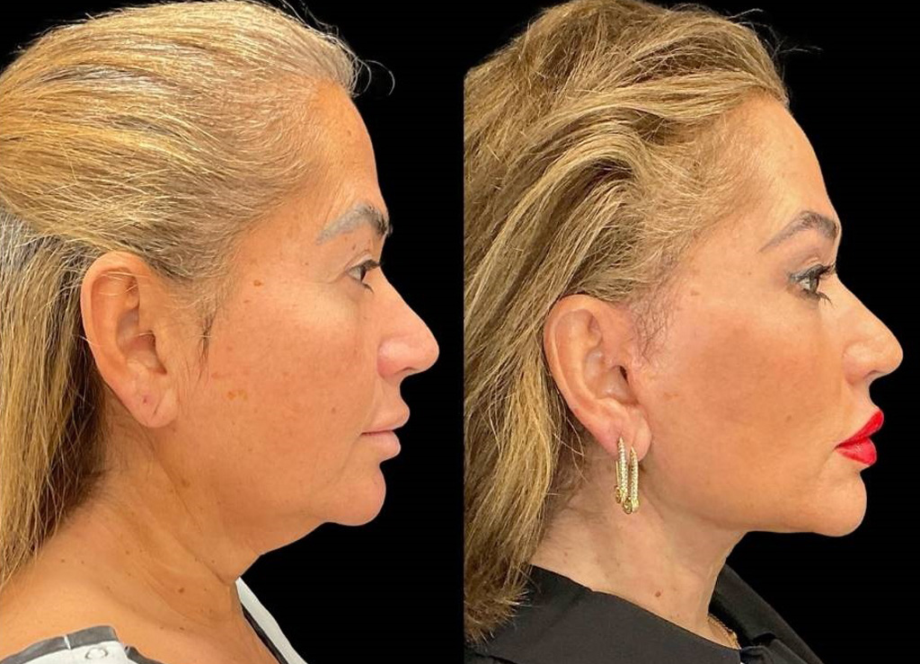 62-yr-old-female-facelift-before-and-after-right-view.jpg